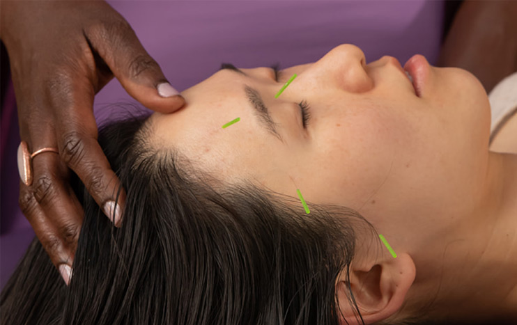 Answering Your Top Five Facial Acupuncture Questions
