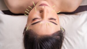 Facial Acupuncture