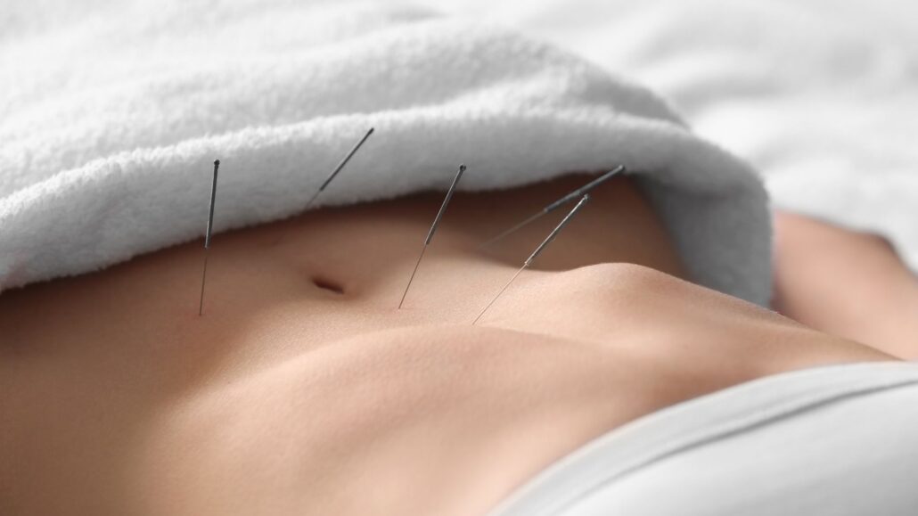 Understanding the Basics of Acupuncture in Fertility 3