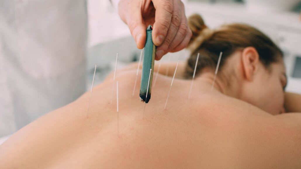 Acupuncture and Fertility: Patient relaxing during acupuncture session aimed at fertility improvement