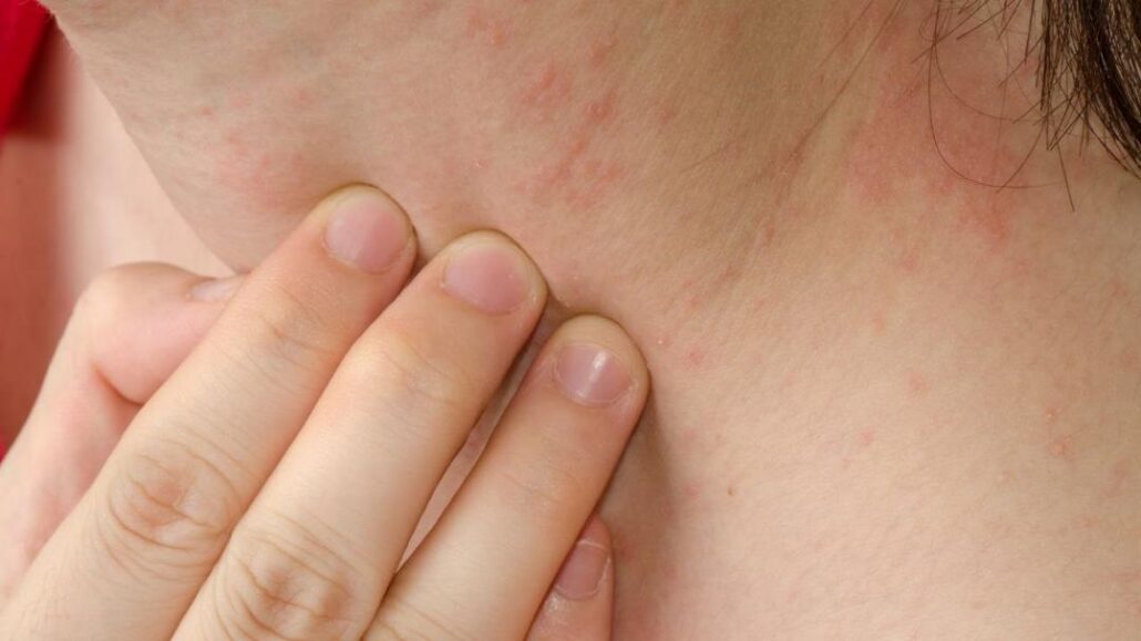 Acupuncture for skin health: natural treatment for eczema and psoriasis