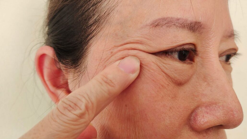 Facial acupuncture for Bell’s palsy