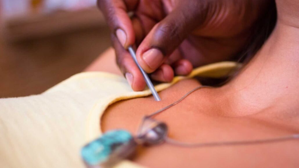 2 ACUPUNCTURE