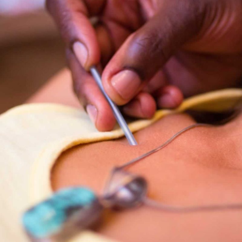 2 - ACUPUNCTURE